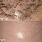 Cynosure Apogee Elite Before After Hair Removal | Medshare Laser