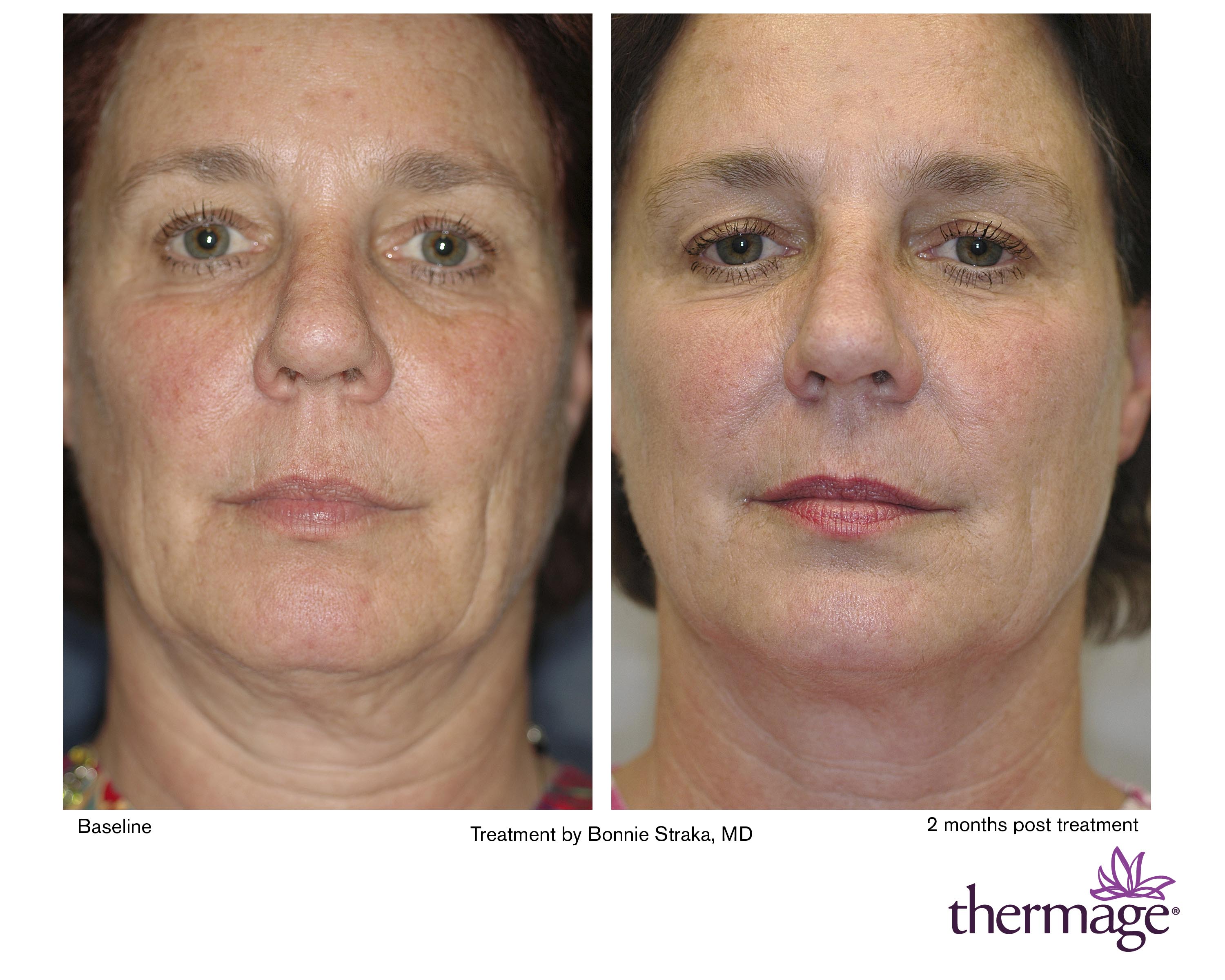 treatment Facial thermage