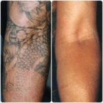 Hoya Con Bio RevLite | Tattoo Removal | Medshare Laser